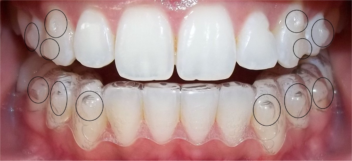 How to effectively use the invisalign treatment as per your requirements